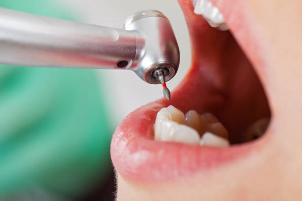 Best Emergency Root Canal Treatment in Oakland City, IN